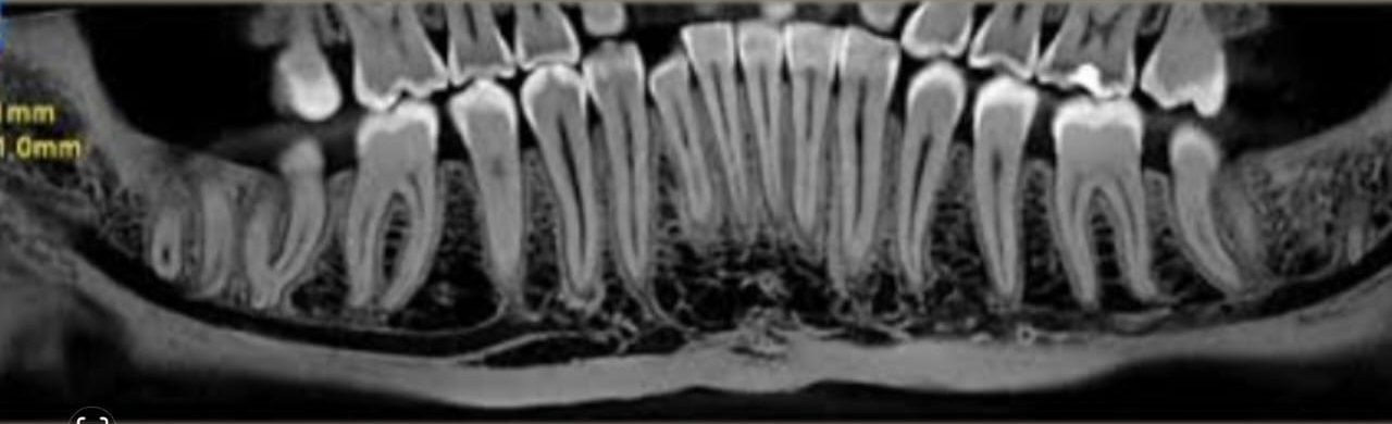 Cône Beam / CBCT